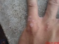 100种皮肤病对照图-各种皮肤病对照图种类